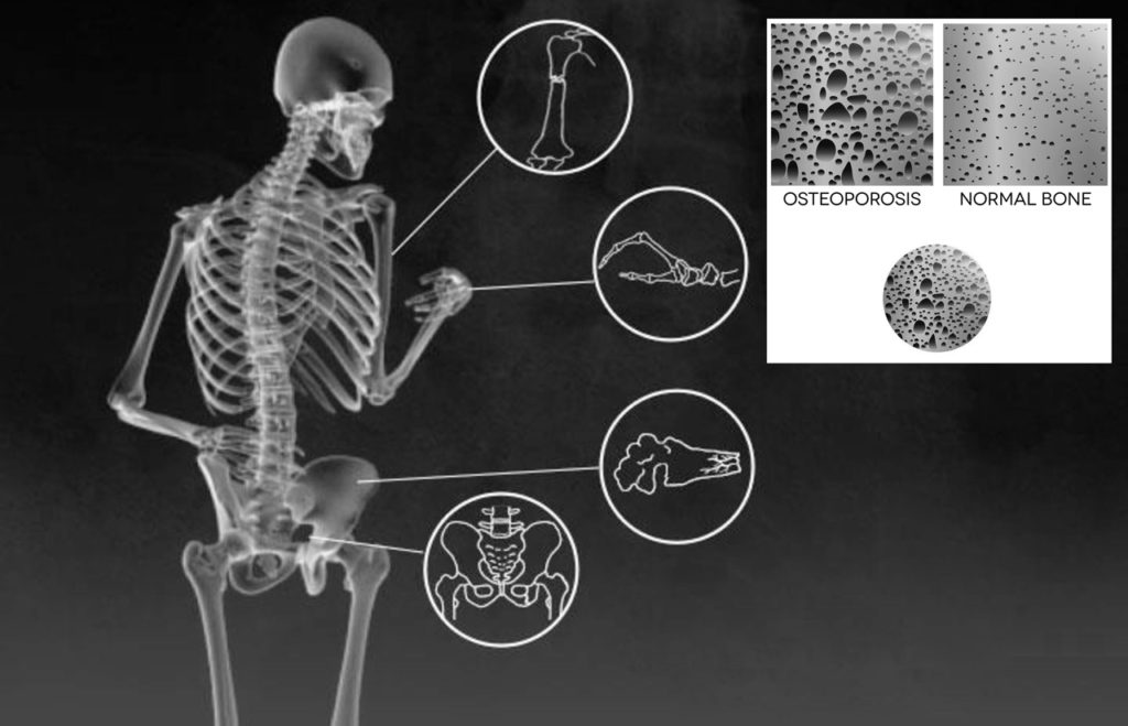 osteoporosi 
